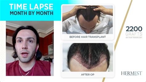 hermest hair clinic reviews|hermest hair transplant cost.